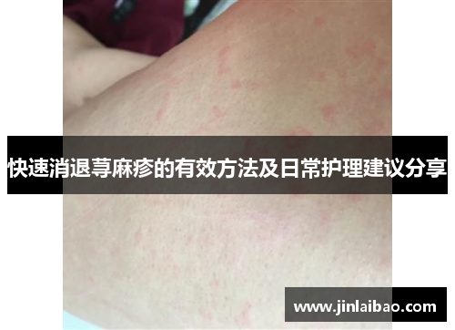 快速消退荨麻疹的有效方法及日常护理建议分享